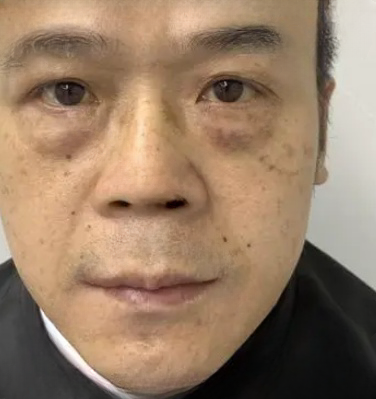 去眼袋手术