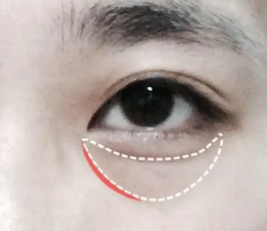 去眼袋手术