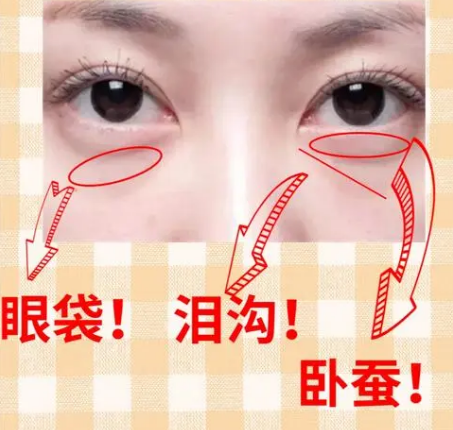 去眼袋手术