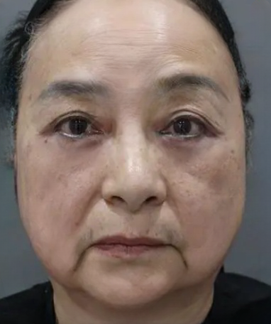 去眼袋手术