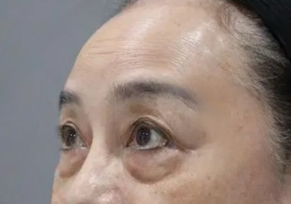 去眼袋手术