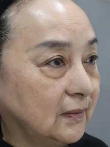 去眼袋手术
