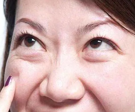 眼袋