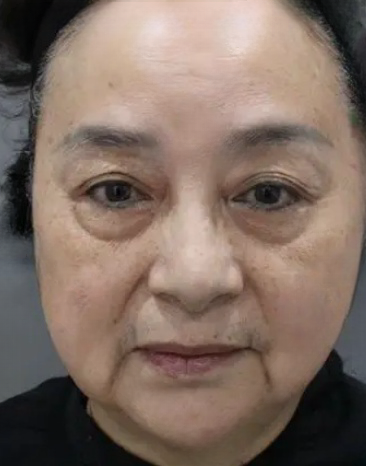去眼袋手术