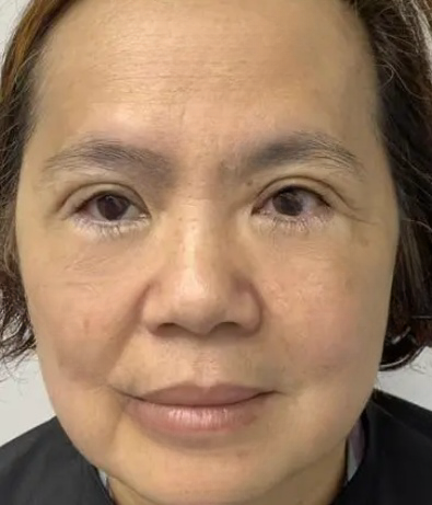 去眼袋手术