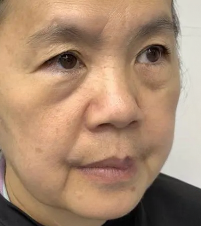 去眼袋手术