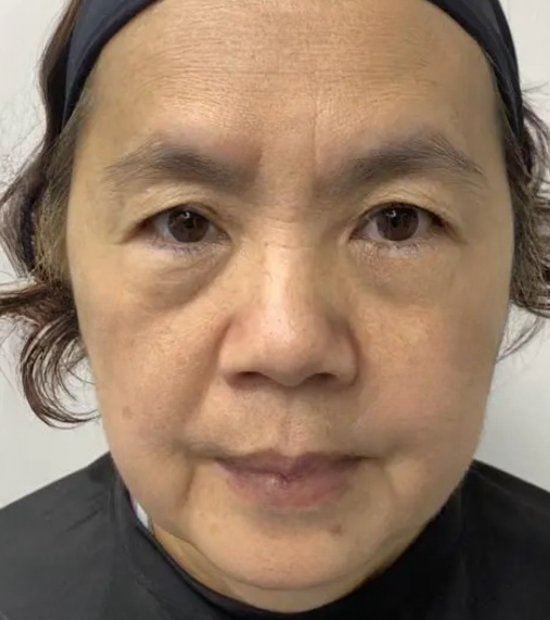 去眼袋手术
