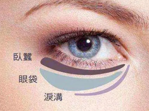 去眼袋手术