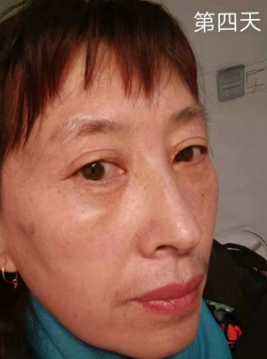 去眼袋手术