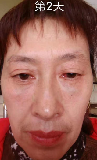 去眼袋手术