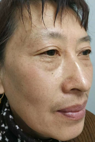 去眼袋手术