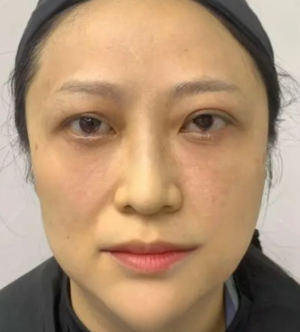 去眼袋手术