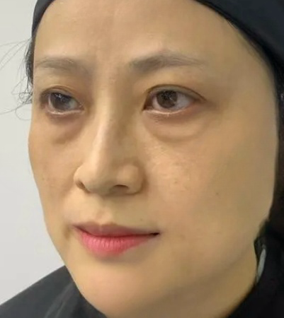 去眼袋手术