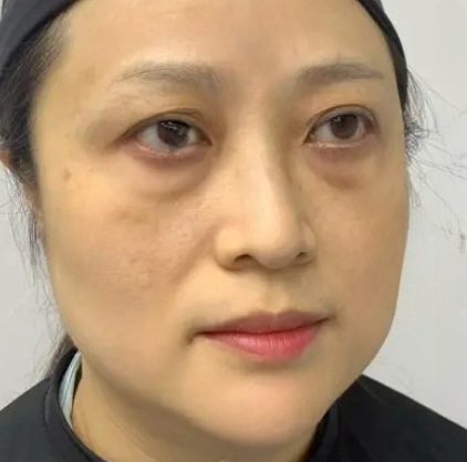 去眼袋手术