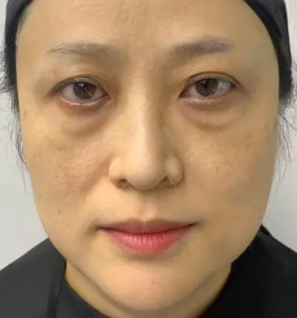 去眼袋手术