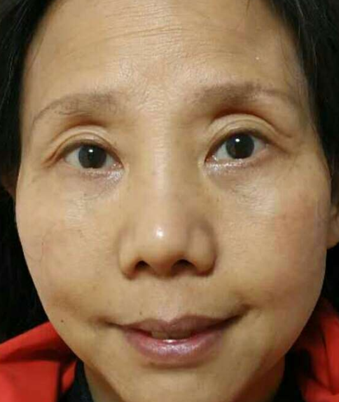 去眼袋手术