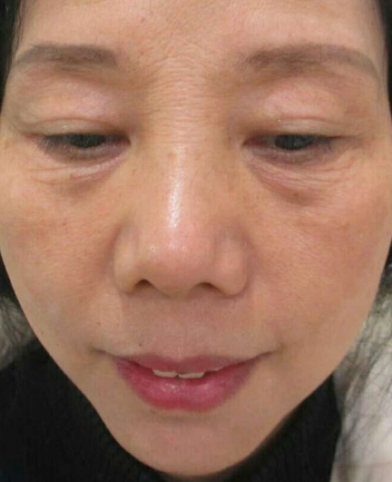 去眼袋手术