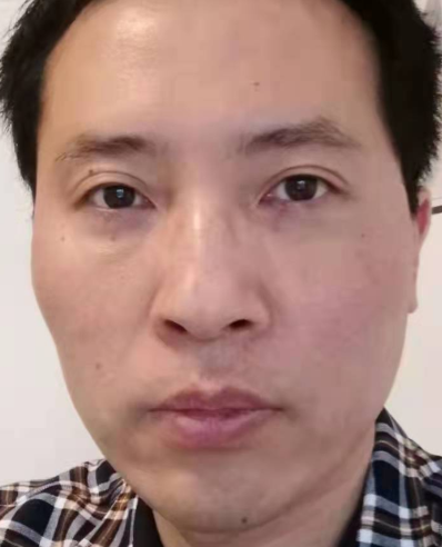 去眼袋手术