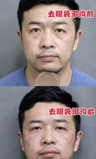 去眼袋手术