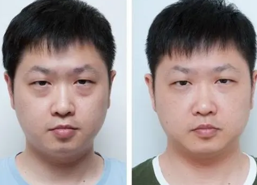 去眼袋手术