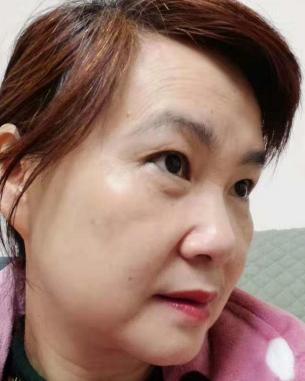去眼袋手术