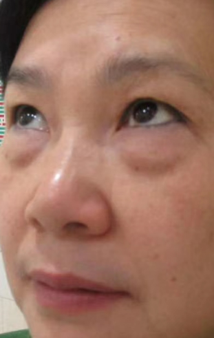 去眼袋手术