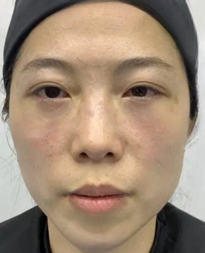去眼袋手术