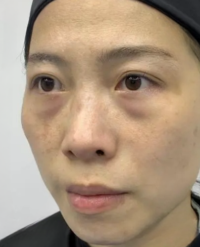 去眼袋手术