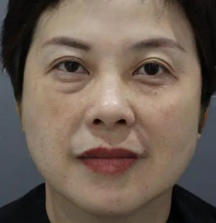 去眼袋手术
