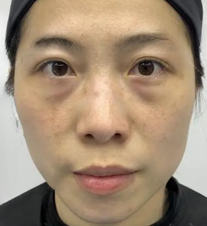 去眼袋手术
