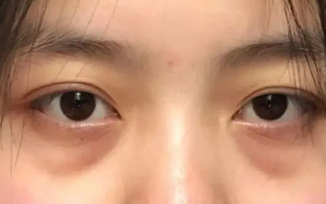 去眼袋手术