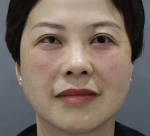 去眼袋手术