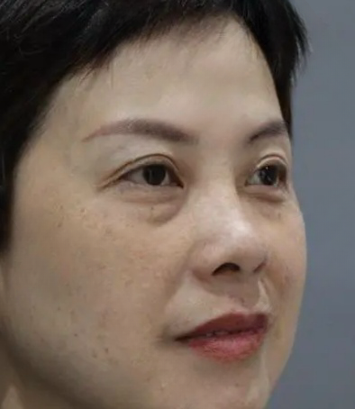 去眼袋手术