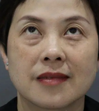 去眼袋手术