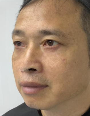 去眼袋手术