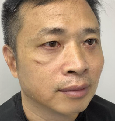 去眼袋手术