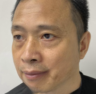 去眼袋手术