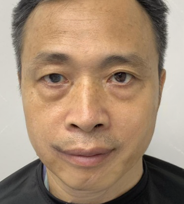 去眼袋手术