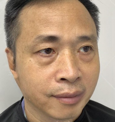 去眼袋手术