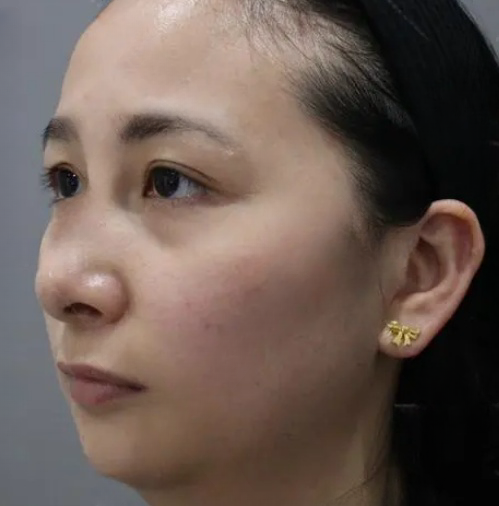 去眼袋手术