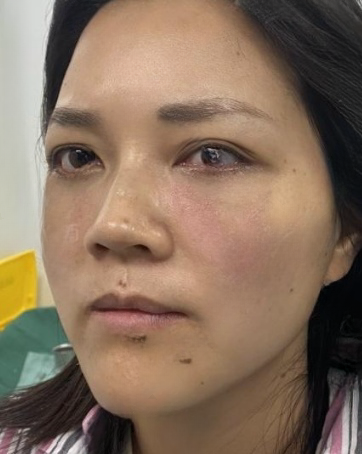 去眼袋手术