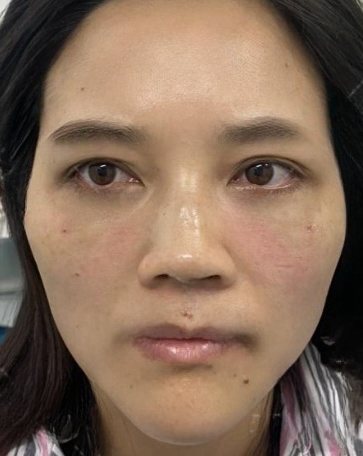 去眼袋手术