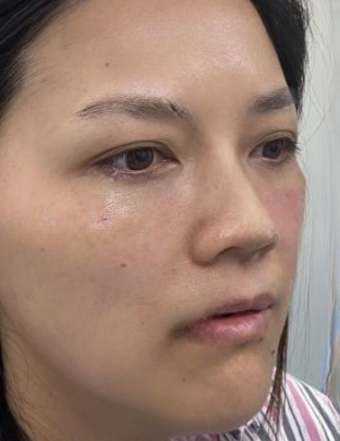 去眼袋手术