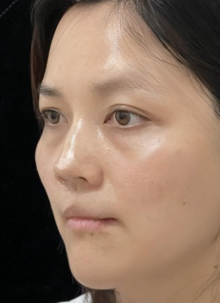去眼袋手术