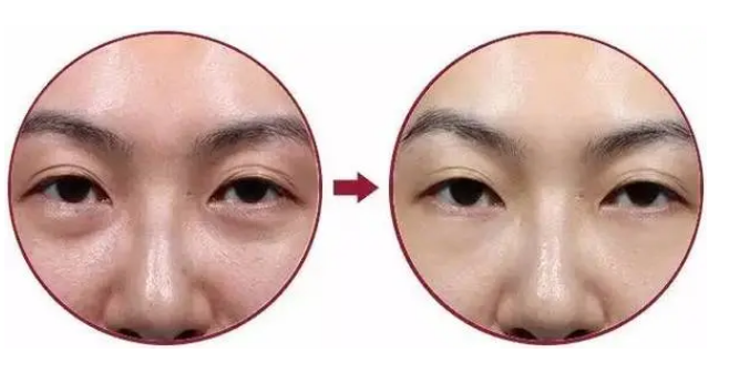 去眼袋手术