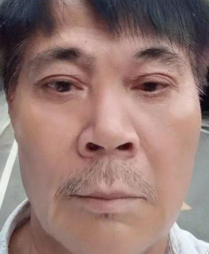 去眼袋手术