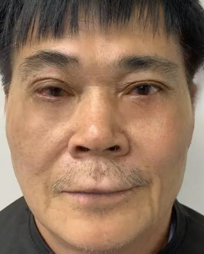去眼袋手术