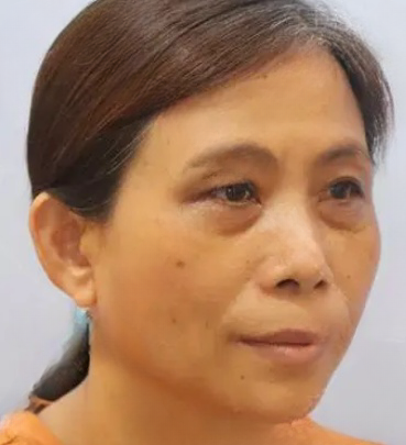 去眼袋手术