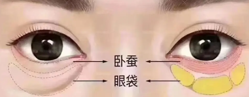 去眼袋手术