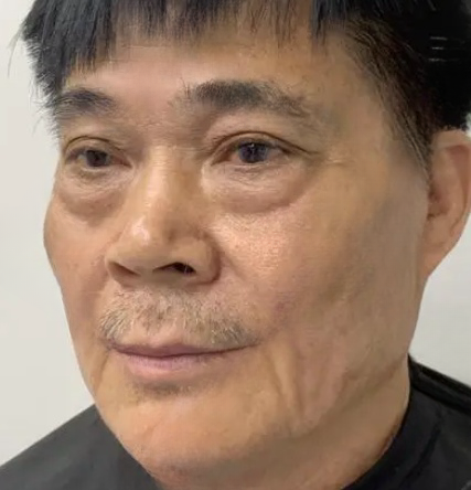 去眼袋手术